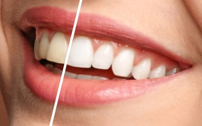 What goes in to Professional Teeth Whitening