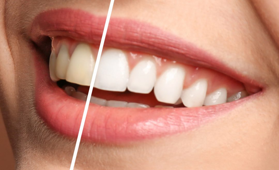 What goes in to Professional Teeth Whitening